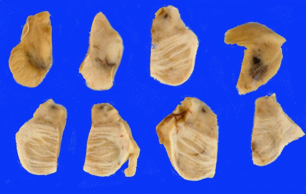 24 Telangiectasis (Case 24) (2)