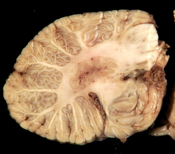 27A Venous Angioma (Case 27) Gross