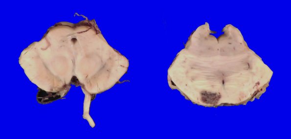 27A Telangiectasis (Case 27) Pons