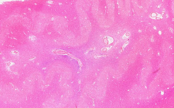 27B1 Venous Angioma (Case 27) Gross