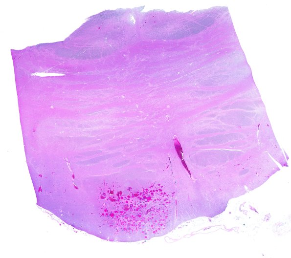 27B1 Telangiectasis (Case 29) N7 H&E WM