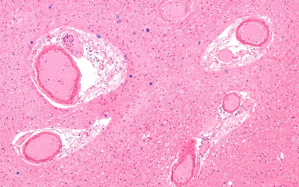 27B2 Venous Angioma (Case 27) Gross