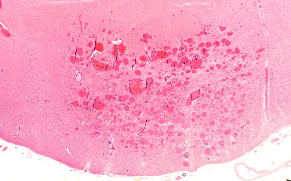 27B2 Telangiectasis (Case 27) N7 H&E 2X