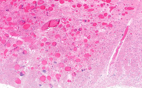 27B3 Telangiectasis (Case 27) N7 H&E 4X