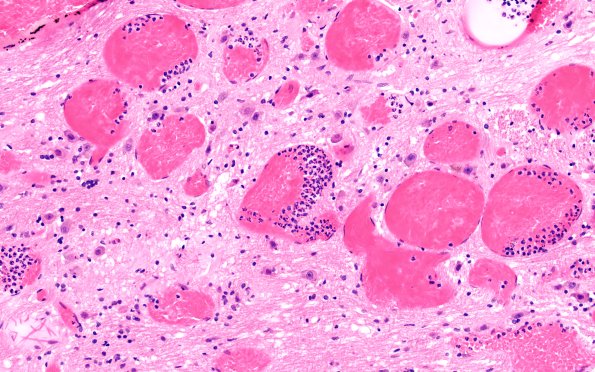 27B5 Telangiectasis (Case 27) N7 H&E 20X 2
