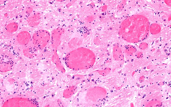 27B6 Telangiectasis (Case 27) N7 H&E20X