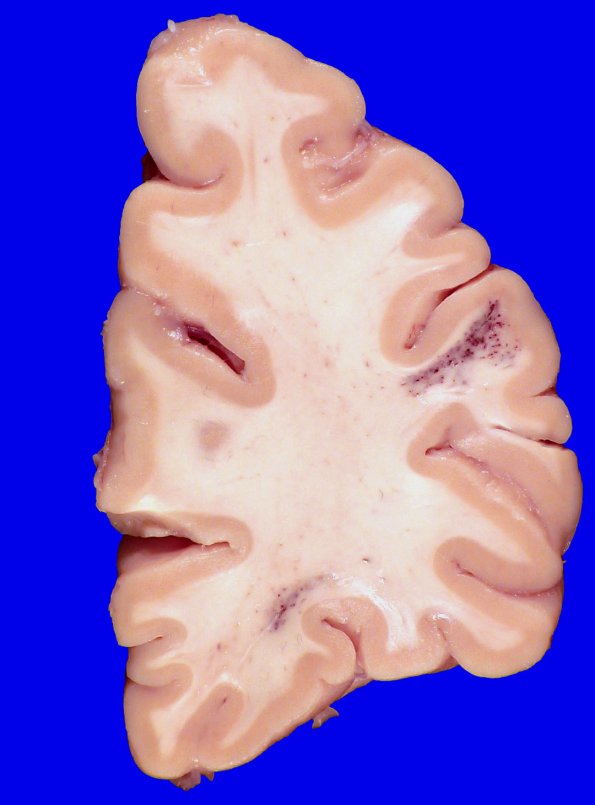 28A1 Telangiectasis (Case 28) 1_1