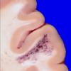 28A2 Telangiectasis (Case 28) 1_2 new