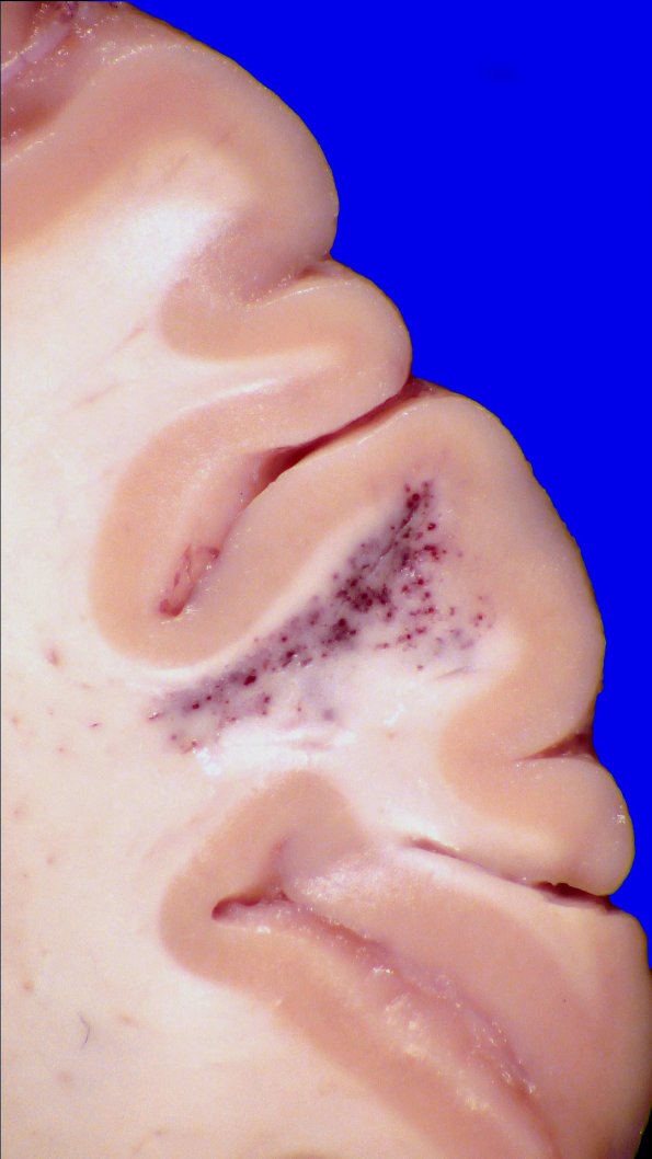 28A2 Telangiectasis (Case 28) 1_2 new