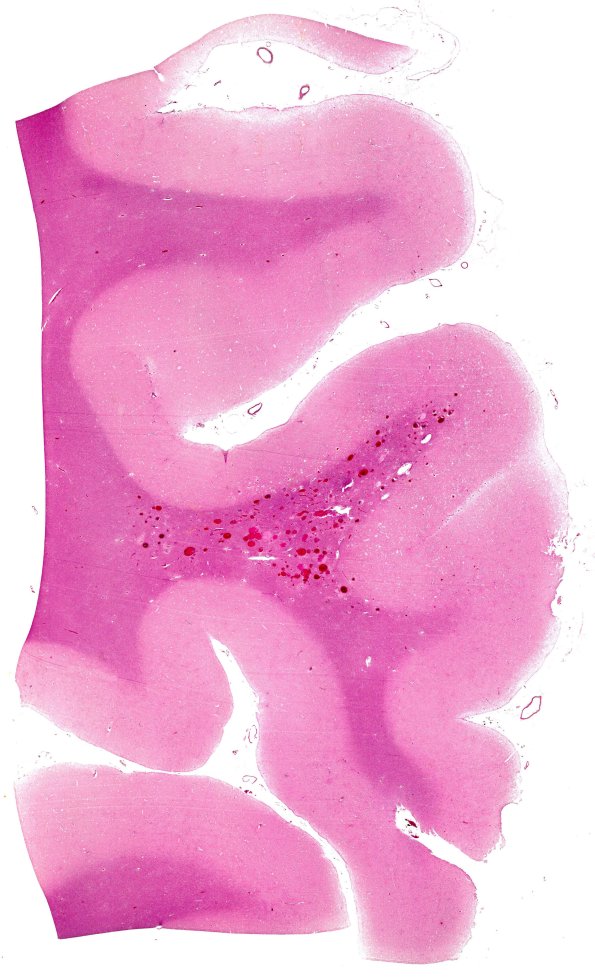 28B1  Telangiectasis (Case 28)_H&E WM