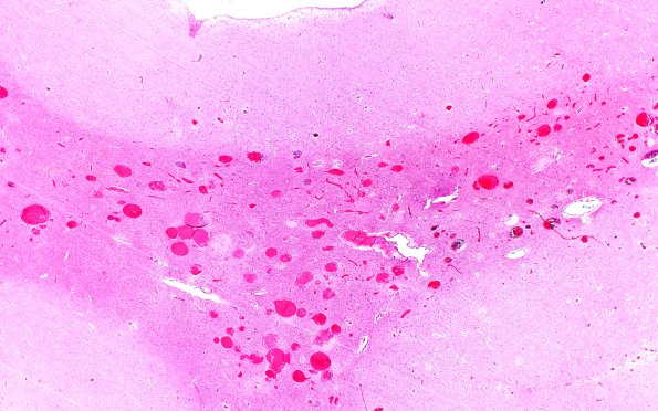 28B2 Telangiectasis (Case 28) H&E 3