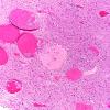 28B3 Telangiectasis (Case 28) H&E A