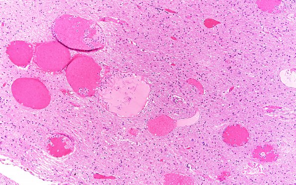 28B4 Venous angioma (Case 28) H&E