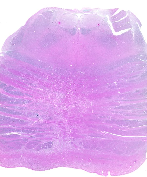 29A1 Telaniectasis (Case 29) WM