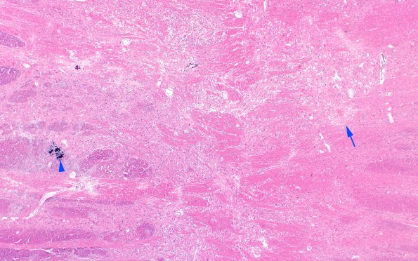 29A2 Telaniectasis (Case 29) 2X copy