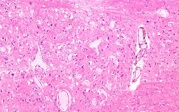 29A3 Telaniectasis (Case 29) 10X