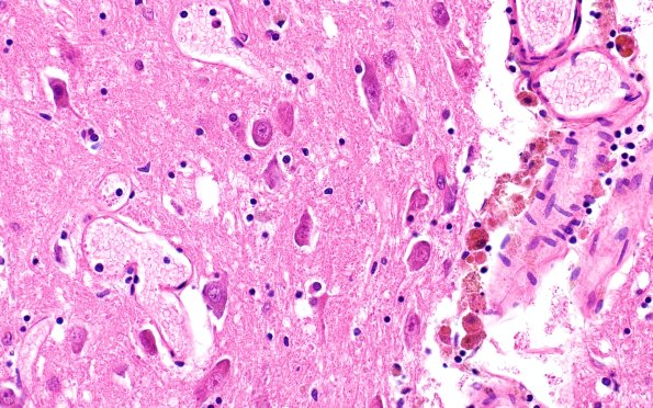 29A4 Telaniectasis (Case 29) 40X 2