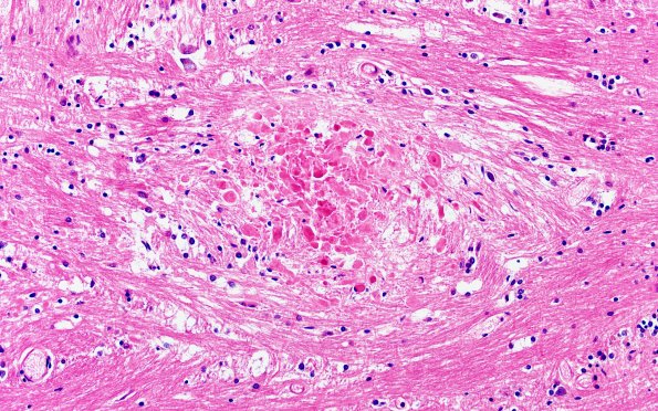 29A5 Telaniectasis (Case 29) 20X 2