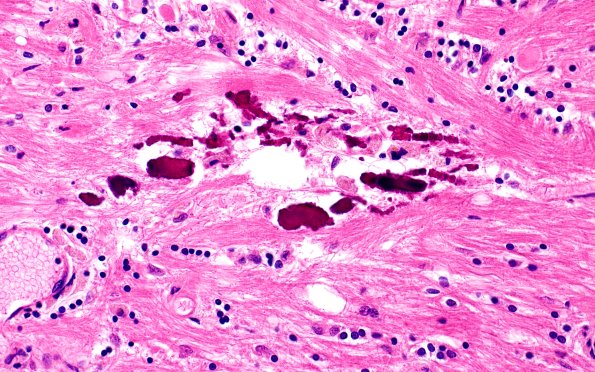 29A6 Telaniectasis (Case 29) 40X 4