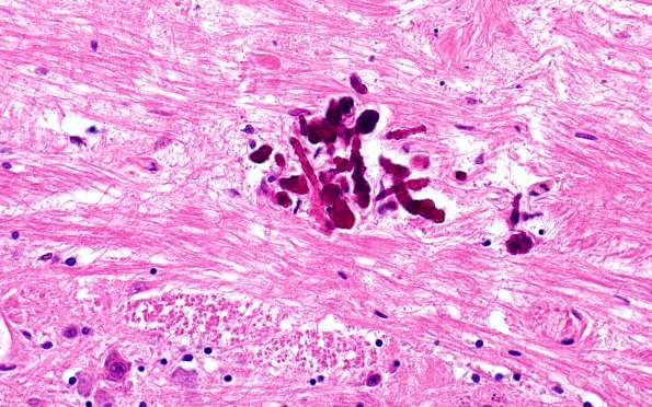 29A7 Telaniectasis (Case 29) 40X