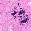 29A8 Telaniectasis (Case 29) 20X