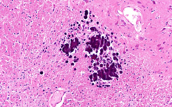 29A8 Telaniectasis (Case 29) 20X