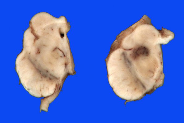 2A Telangiectasis (Case 2) gross