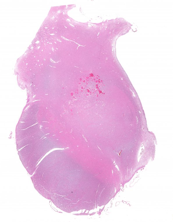 2B1 Telangiectasis (Case 2) H&E 5