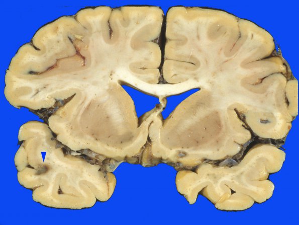 3A1 DVI, multiple (Case 3) 1 copy