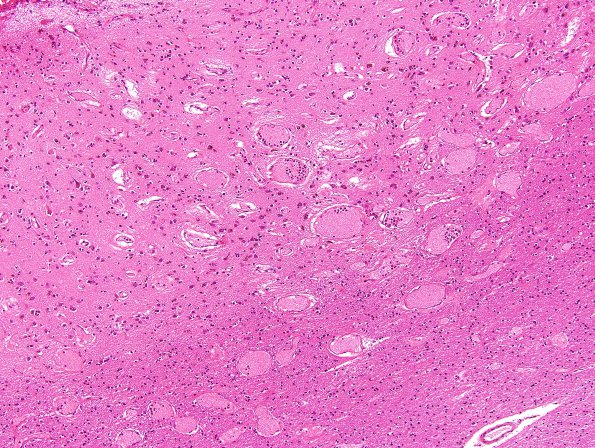 3B3 Telangiectases, multiple (Case 3) H&E 1.jpg