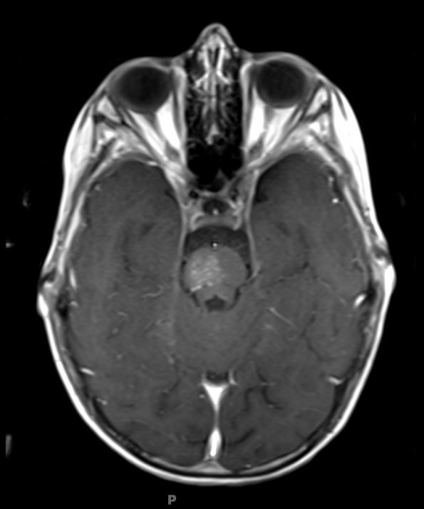 4A0 Telangiectasis (A14-196) T1W