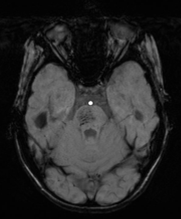 4A1 Telangiectasis (A14-196) SWI 1