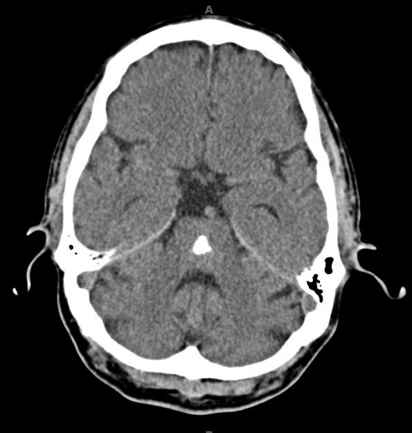 5A1 Telangiectasis, pons (Case 5) CT - Copy