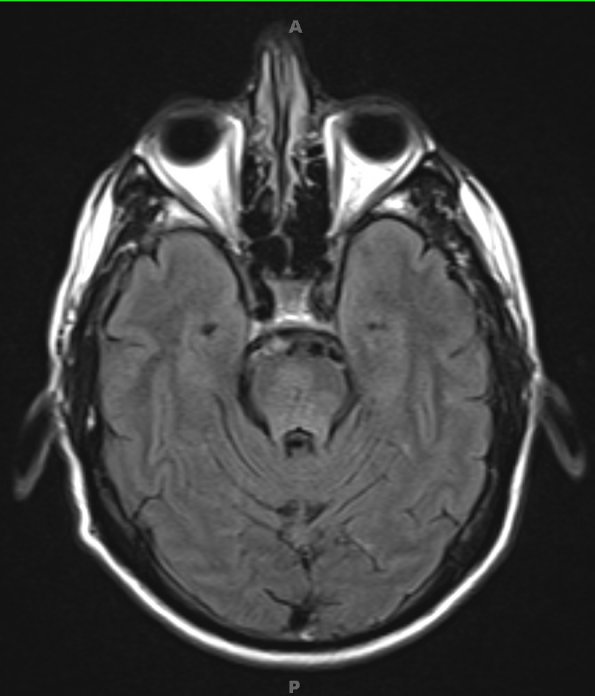 5A2 Telangiectasis, pons (Case 5) FLAIR - Copy