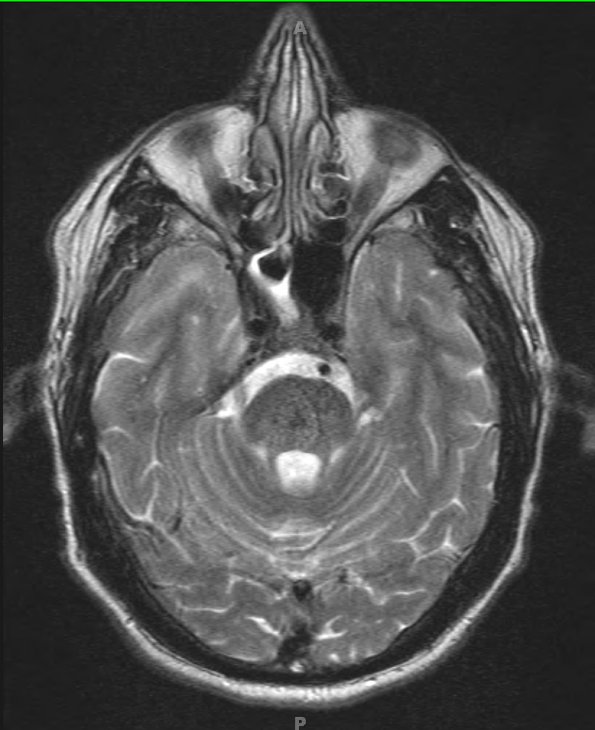 5A4 Telangiectasis, pons (Case 5) T2 with contrast 1 - Copy