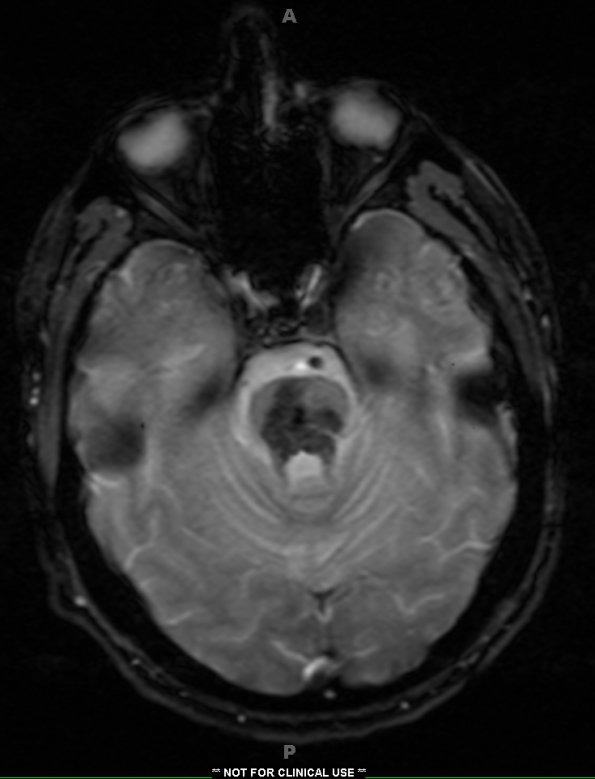 5A5 Telangiectasis, pons (Case 5) T2star-weighted gradient echo heme - Copy