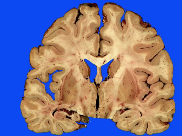 5B1 Telangiectasis, atypical&OlivHT (Case 5) 4