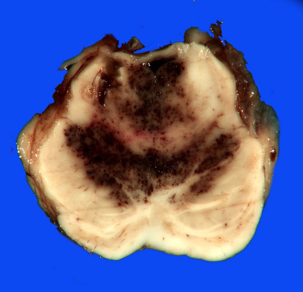 5B2 Telangiectasis, atypical&OlivHT (Case 5) 7