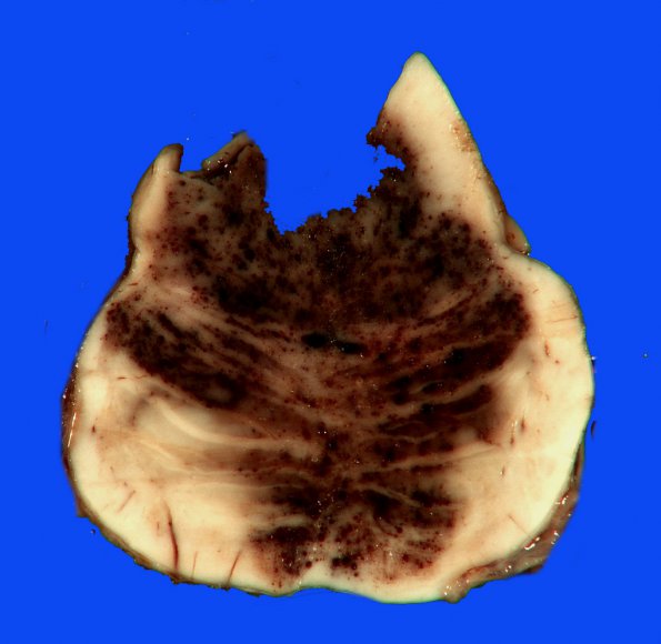 5B3 Telangiectasis, atypical&OlivHT (Case 5) 8