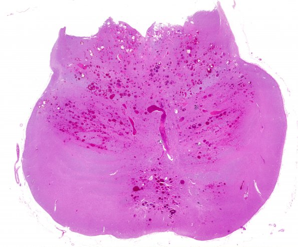 5C1 Telangiectasis, atypical&OlivHT (Case 5) N15 H&E  WM