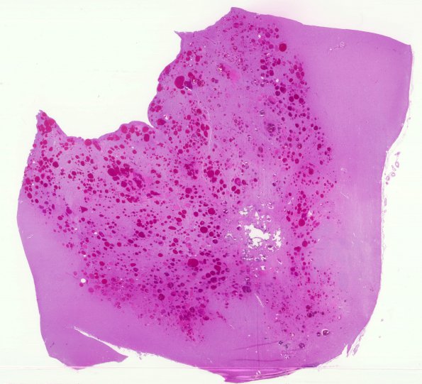 5C2 Telangiectasis, atypical&OlivHT (Case 5) N7 H&E WM