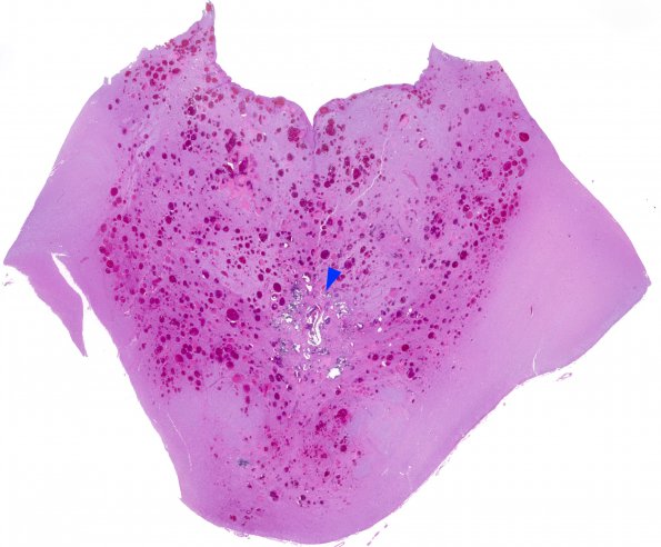 5C3 Telangiectasis, atypical&OlivHT (Case 5) N7 H&E medulla WM copy