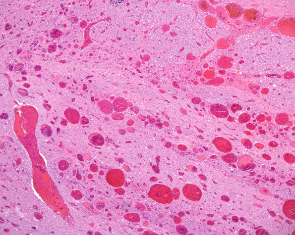 5C4 Telangiectasis, atypical&OlivHT (Case 5) H&E 1.jpg