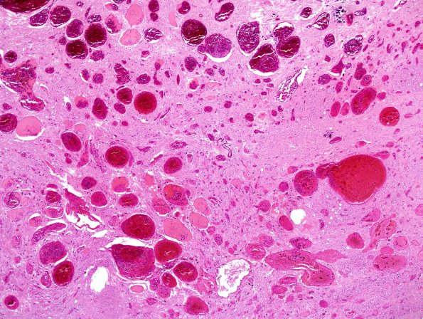 5C5 Telangiectasis, atypical&OlivHT (Case 5) H&E 2.jpg