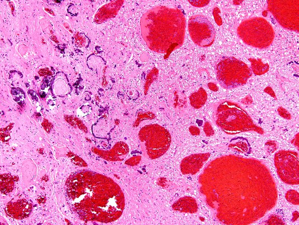 5C6 Telangiectasis, atypical&OlivHT (Case 5) H&E 10X