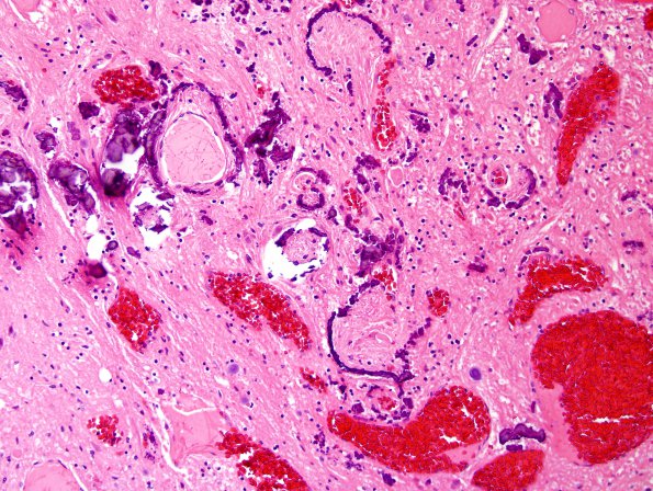 5C7 Telangiectasis, atypical&OlivHT (Case 5) H&E 8.jpg