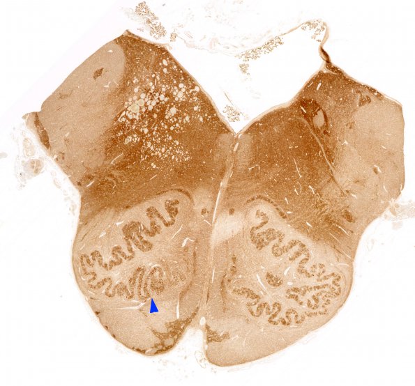 5L1 Telan&OliveHT (Case 5) SYN  WM copy