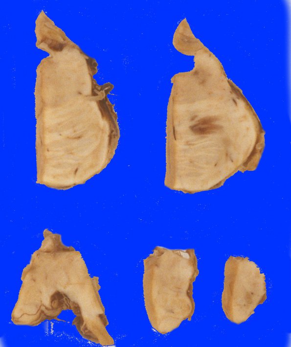 6A Telangiectasis (Case 6)