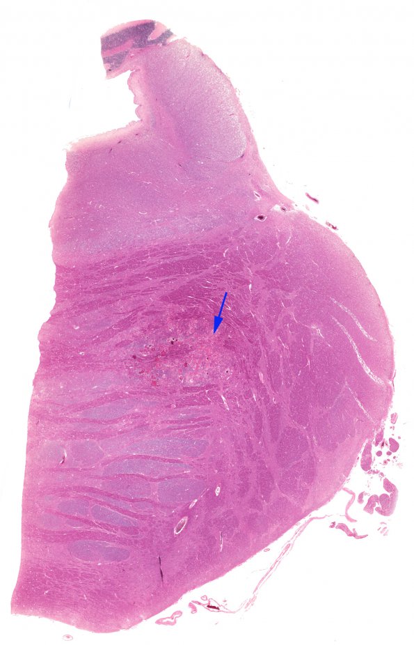 6B1 Telangiectasis (Case 6) H&E 11A WM copy