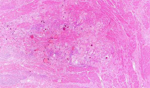 6B2 Telangiectasis (Case 6) 11A 2X